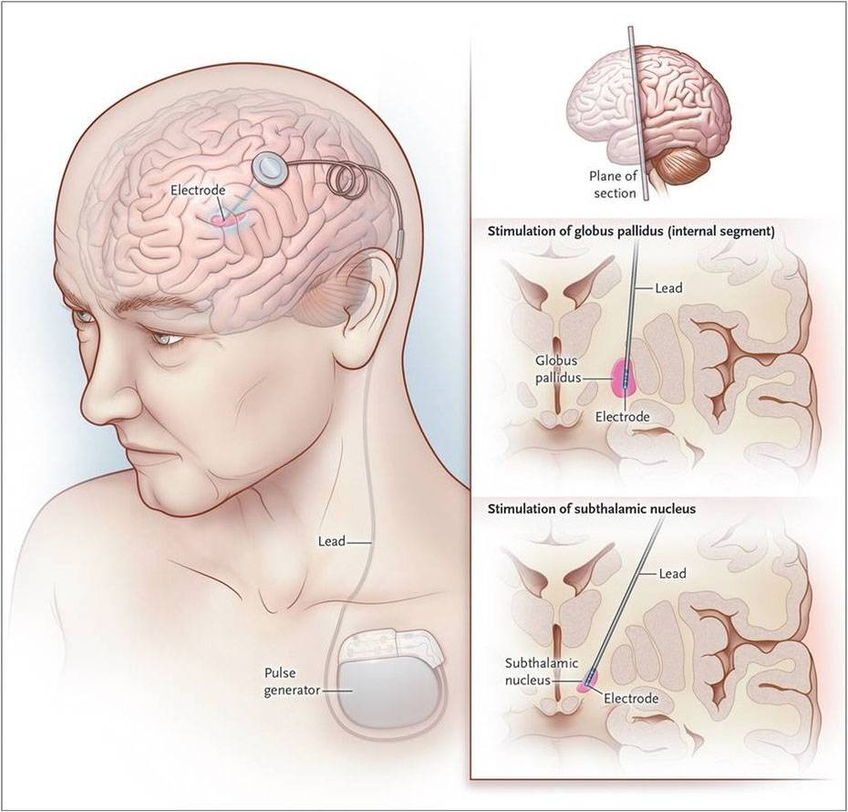 经颅磁刺激(TMS)有望治疗帕金森等多种神经疾病