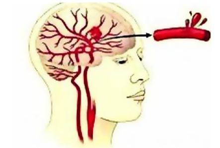择思达斯经颅磁——脑出血如何做康复治疗 