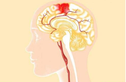 经颅磁刺激应用领域_发生脑溢血有没有前兆 